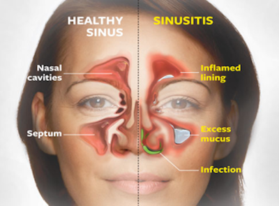 instantaneous remedy for sinus headache