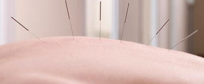 Acupuncture