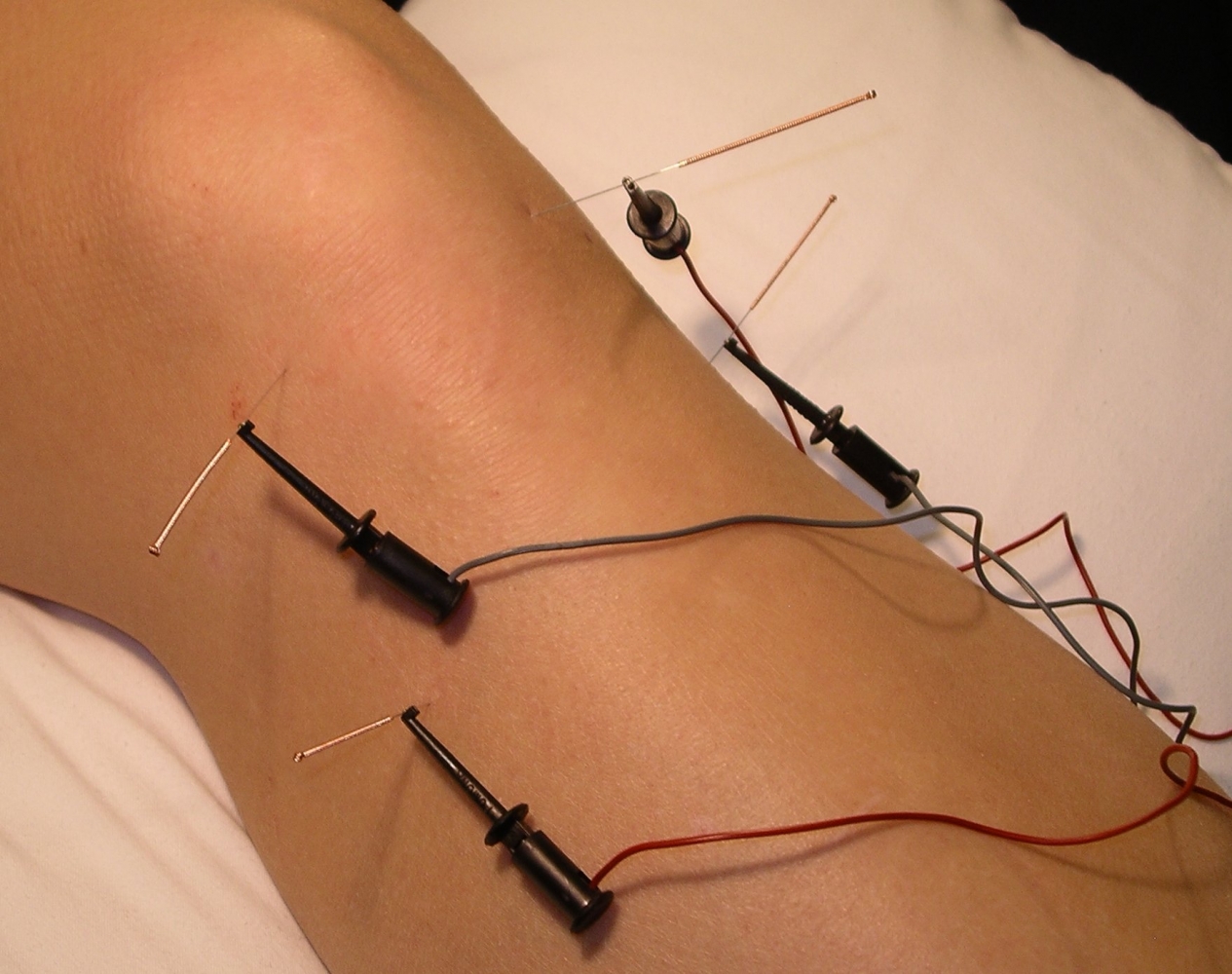 Using Electronic Stimulation with Acpuncture