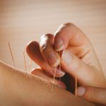 acupuncture needles